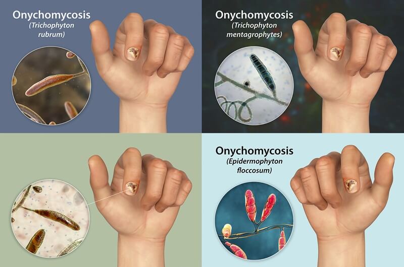 Toe Nails Fingernails Feet Fungus Onychomycosis Treatment - White Marks Anti Fungal Infection