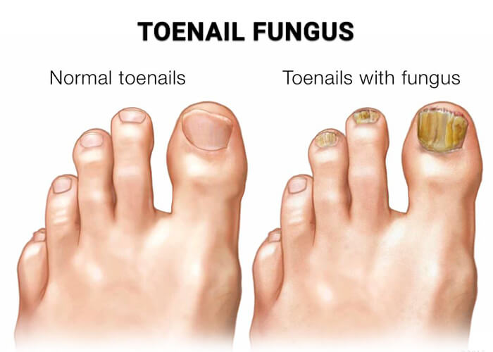 Toe Nails Fingernails Feet Fungus Onychomycosis Treatment - White Marks Anti Fungal Infection