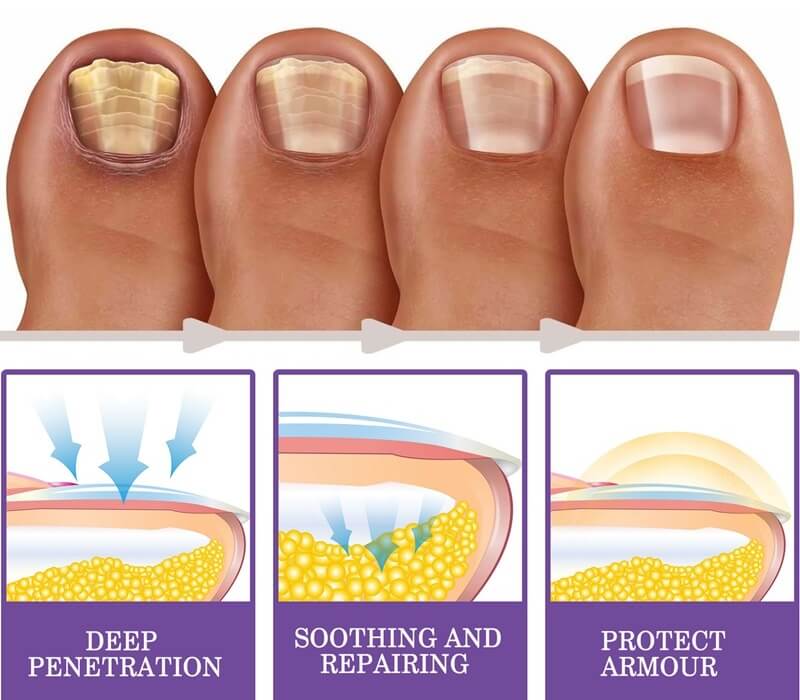 Toe Nails Fingernails Feet Fungus Onychomycosis Treatment - White Marks Anti Fungal Infection