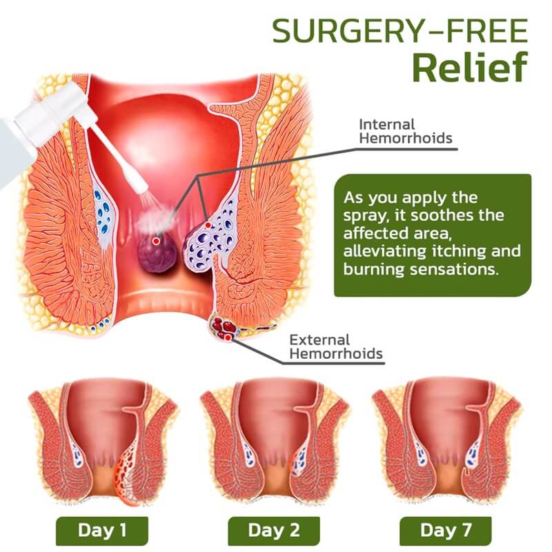 External Internal Hemorrhoids And Piles Self Care Relief Treatment