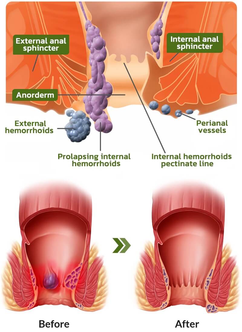 External Internal Hemorrhoids And Piles Self Care Relief Treatment