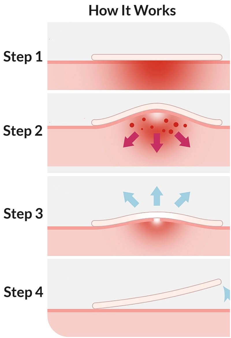Hydrocolloid Pimple Patches - Stickers For Zit Acne Blemish