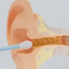 Ear Wax & Cerumen Removal Kit - Ear Dirt Remover & Impacted Earwax Cleaner