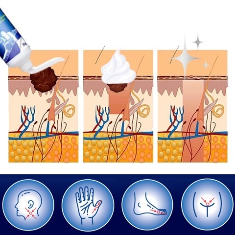 Plantar Wart Removal Natural Treatment On Feet Hands Finger Toe At Home