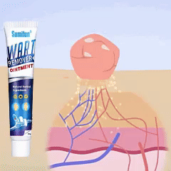 Plantar Wart Removal Natural Treatment On Feet Hands Finger Toe At Home
