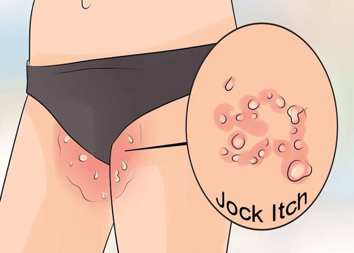 Jock Itch Antifungal Cream Treatment For Tinea Cruris