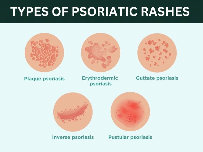 Plaque Psoriasis Rash Treatment On Scalp Face Hand Feet - Anti Itch & Scratch Skin Cream