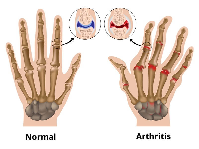 Rheumatoid Arthritis​ & Carpal Tunnel Syndrome Treatment​ - Tenosynovitis & Wrist Pain​